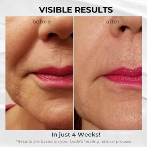 Nose-to-Mouth Wrinkle Treatment with UV Chromophores - Reduce Appearance of Fine Lines, Lip Wrinkles, Lip Lines, Retain Skin Firmness, Anti-Aging (0.5 oz)