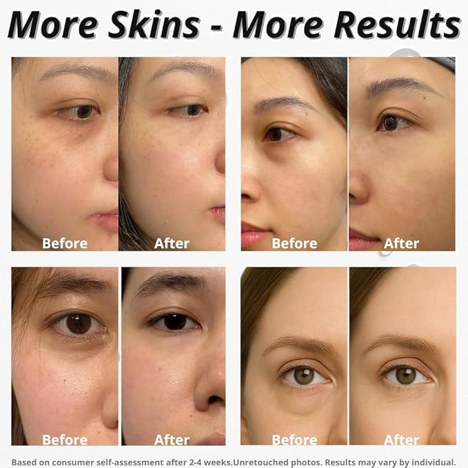 Caffeine + Bakuchiol Eye Serum for Dark Circles, Puffiness Eyes with Argireline & Copper Peptides (GHK-Cu) – Roll-on Under Eye Serum, Anti-Aging Wrinkle Care for Fine Lines– 20ml