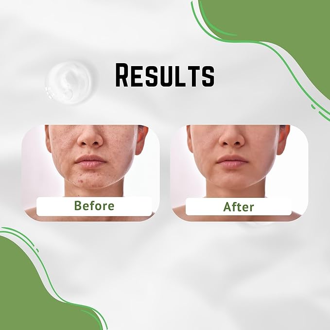 Aloe Vera Cream, Correct Dark Marks, Dry Skin and New Scars on Body, Face Cream for Blemishes, Reduce Appearance of Scars from Acne, Dark Spot Remover For Men, Women and Kid