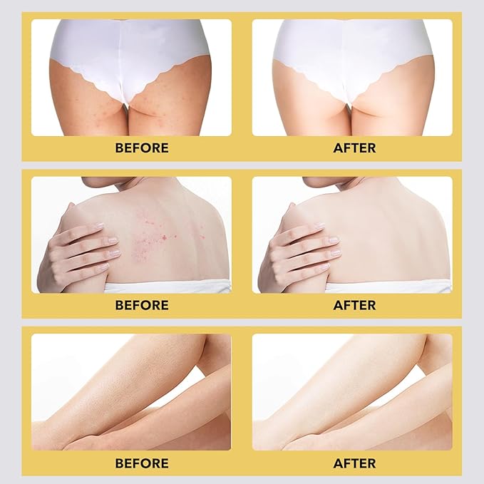 Turmeric Vitamin C Butt Body Scrub Exfoliator for Black Pore Deep Cleaning, Butt Acne/Back Excess Sebum/Oil/Inner Thigh/Elbow/Foot Dead Skin Cell/Ingrown Hair, Body Care-7.06 OZ