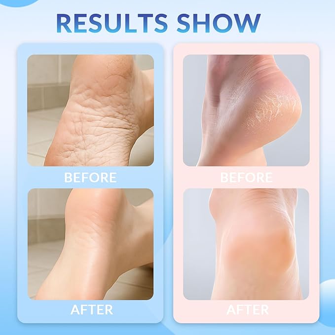 Anti Crack Foot Cream Stick, Crack Feet Prevention Stick, Foot Care Cream Roll On, Dead Skin Removal Moisturizer, Callus Remover For Dry Feet (Blue*2)