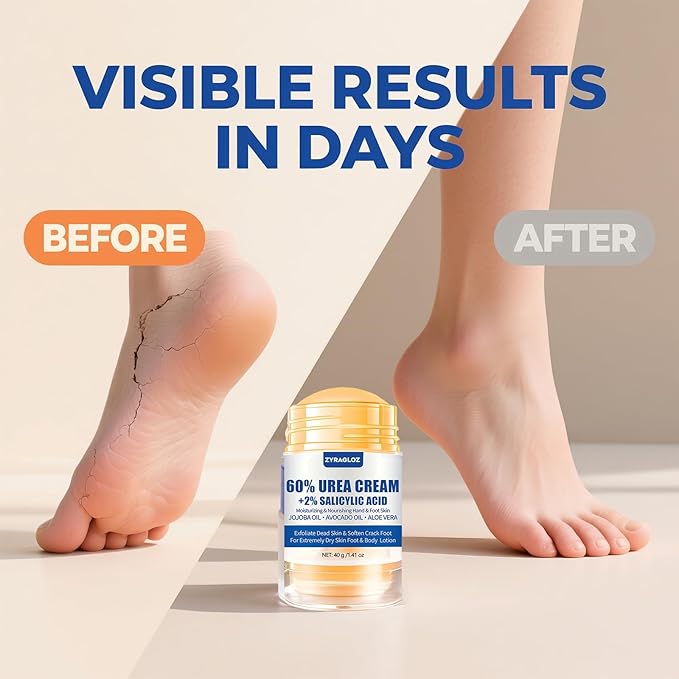 Urea Cream Stick 60% plus 2% Salicylic Acid, 2PCS Maximum Strength Urea Cream for Feet, Foot Lotion Stick for Cracked Heels, Dry Hands & Rough Knees, Callus Remover & Skin Softener, Soften Dead Skin