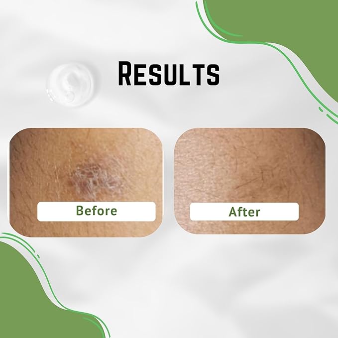 Aloe Vera Cream, Correct Dark Marks, Dry Skin and New Scars on Body, Face Cream for Blemishes, Reduce Appearance of Scars from Acne, Dark Spot Remover For Men, Women and Kid