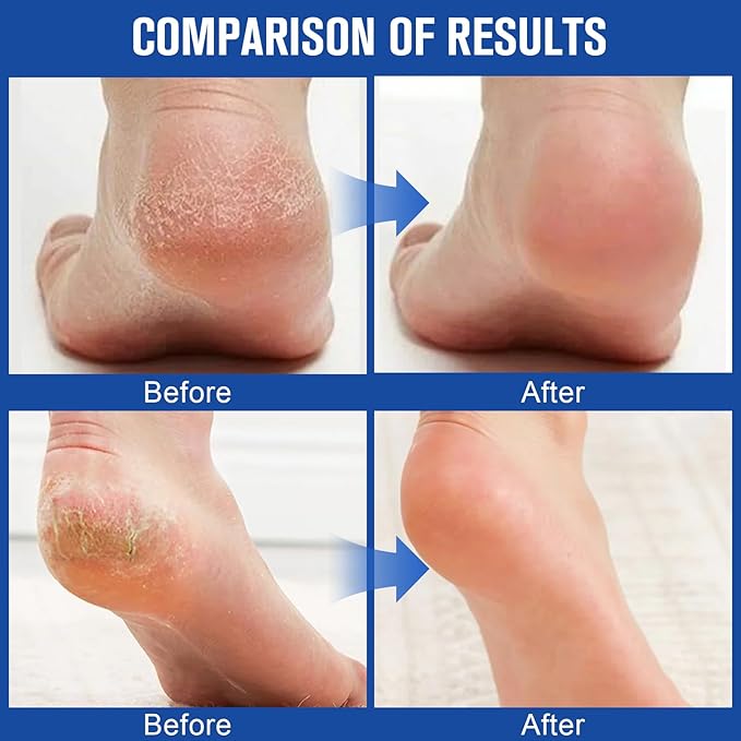 60% Urea Cream + 2% Saliculic Acid, 60 Percent for Feet Maximum Strength Cream, Moisturizing & Nourishing Hand & Foot Skin, for Extremely Dry Skin Foot & Body Lotion (2PCS)