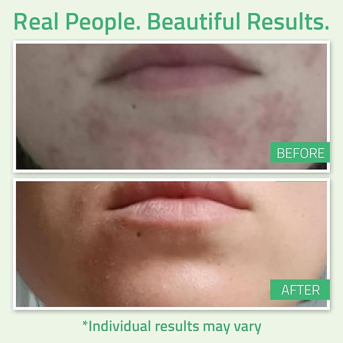 YEOUTH Glycolic Acid Peel for Face, At Home Chemical Exfoliator AHA 30% Glycolic Acid Face Peel with Retinol, Designed to Refresh and Smooth the Appearance of Skin 2oz