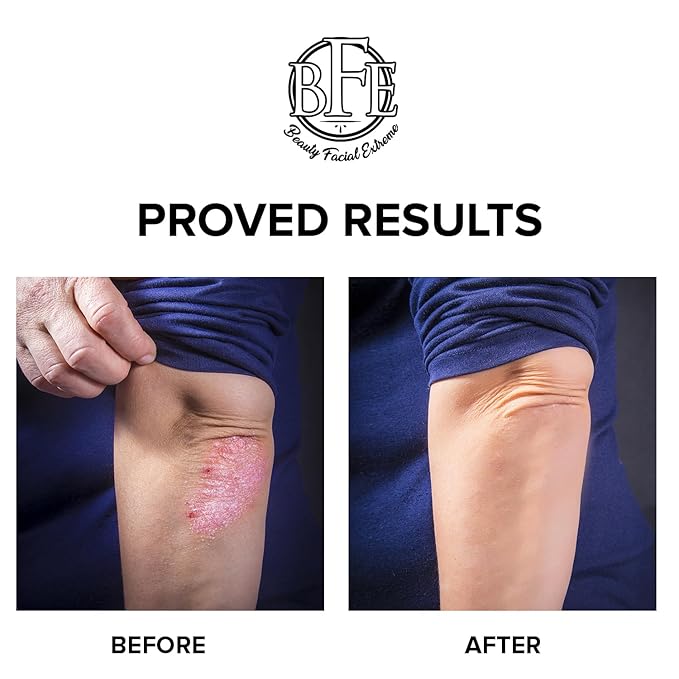 Keratosis Pilaris Exfoliating Body Lotion– 12% Lactic Acid. Provides Immediate Moisture & Gentle Exfoliation to Treat symptoms Associated with Keratosis Pilaris & Dry, Bumpy Skin Conditions.