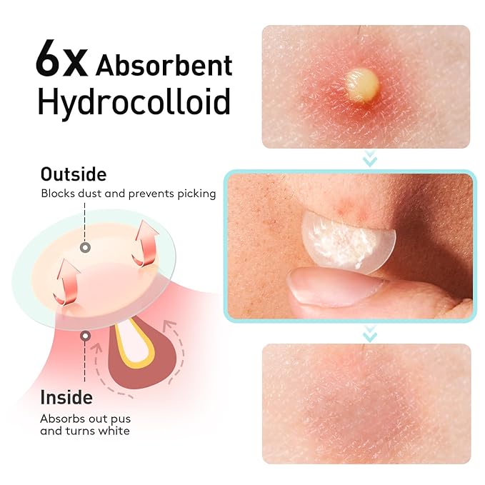 TKTK Pimple Patches, 12mm Invisible Acne Patches for Face with Salicylic Acid, 0.01cm Extra Thin Outer Edge, Hydrocolloid Zit Patch for Pustule, Whitehead, Cystic Acne Spot, 96 Count
