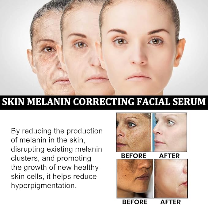 2025 Melanin Correcting Facial Serum, Dark Spot Corrector Daily Face Serum, Melanin Correcting Facial 2pc