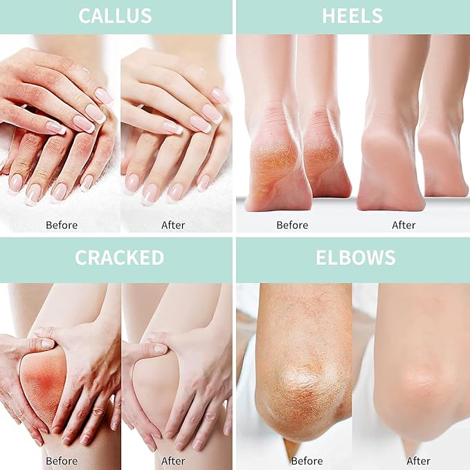 Grocerism Urea Cream 50 Percent for Feet with Coconut 5.29 oz || Foot & Hand Cream Maximum Strength with 2% Salicylic Acid, Tea Tree and Aloe Vera for Deep Moisturizing and Callus Removing