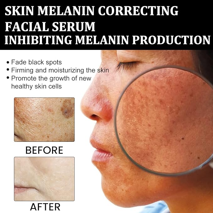 Melanin Correcting Facial Serum, Dark Spot Corrector Daily Face Serum, Melanin Correcting Facial (3pcs)