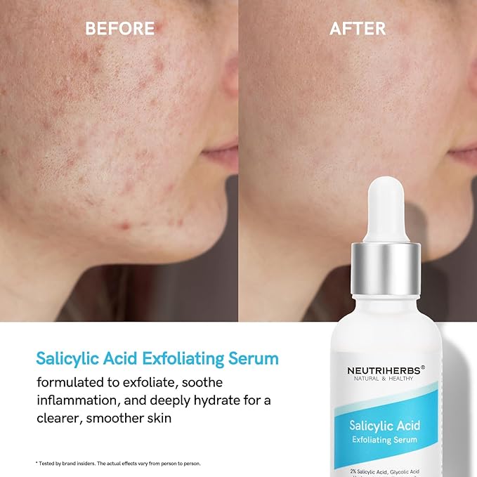 NEUTRIHERBS Salicylic Acid Exfoliating Serum, Unclogged And Minimized Pores, Face Serum For Acne Prone & Oily Skin - 1 fl oz