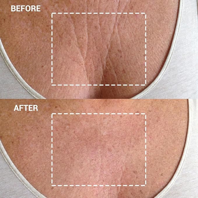 Wrinkles Schminkles Chest, Cleavage & Body Stretch Mark Wrinkle Patches | Reusable Hypoallergenic Pregnancy Safe Silicone Smoothing Pads to Prevent and Reduce Wrinkles & Stretch Marks | 2 Pack