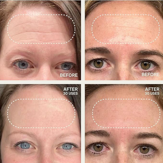 Dermaclara Forehead Patch - Forehead Wrinkle Patches for Face Overnight, Silicone Patches, Reusable Treatment for Wrinkles, Repair & Restore, Up to 30 Uses - 1 Patch
