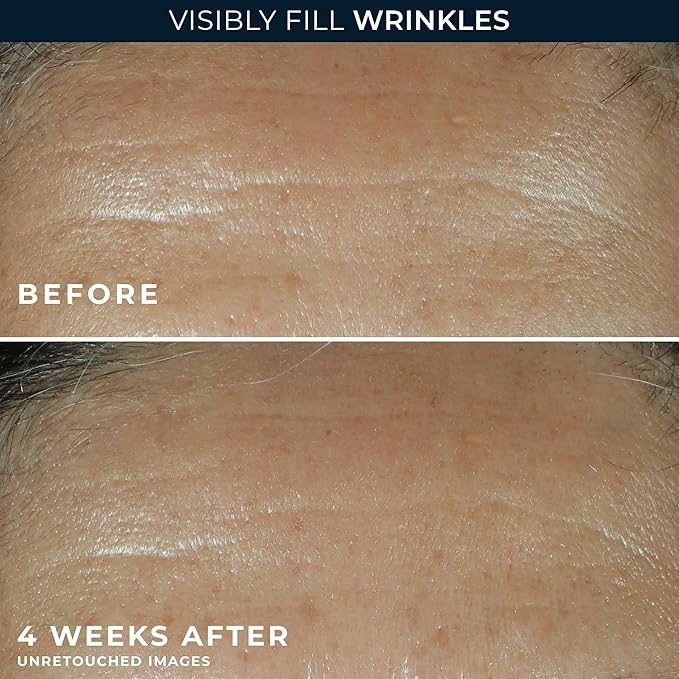 RoC Retinol Correxion Wrinkle Filler for Deep Wrinkles with Hyaluronic Acid & Retinol, Skin Care for Women and Men, 1 Fl Oz (Packaging May Vary)
