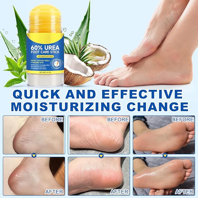 60% Urea with 2% Salicylic Acid Urea Foot Care Stick, 60% urea foot cream for Feet Maximum Strength, Foot Cream Moisturizer for Dry Cracked Feet, Knees, Elbows, Hands, Moisturise & Soften Skin (40G)