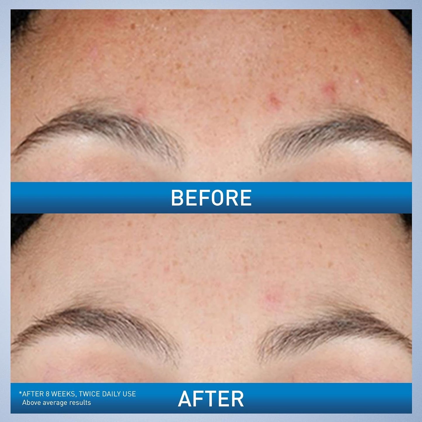 Resurfacing Retinol Serum – Post-Acne Marks & Pore Care ✨💧