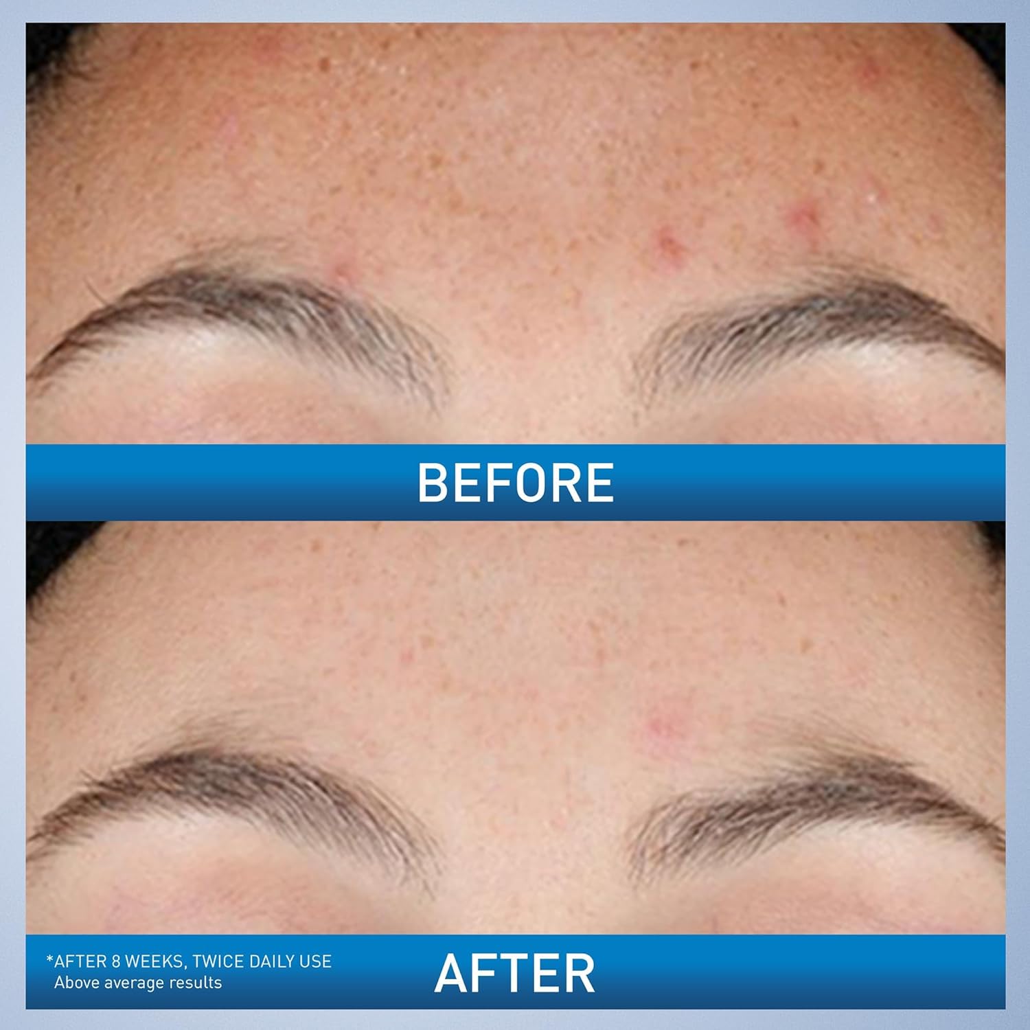 Resurfacing Retinol Serum – Post-Acne Marks & Pore Care ✨💧
