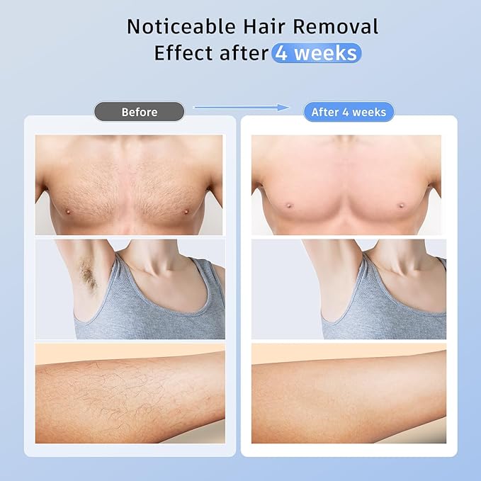 Laser Hair Removal with 5℃ Ice Cooling, Ubroo Painless IPL Laser Hair Removal Device 3 In 1 At Home Hair Remover Machine Permanent Hair Removal for Women Men Facial Body Use(Gold)