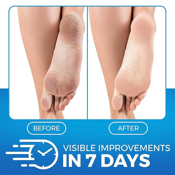 Imperial Feet Urea Foot Balm - Natural Urea Cream for Foot Care, Cracked Heel Repair, Rough Skin, Dryness, Calluses - Cleansing, Exfoliant - Wild Herb Extract - 5.07oz