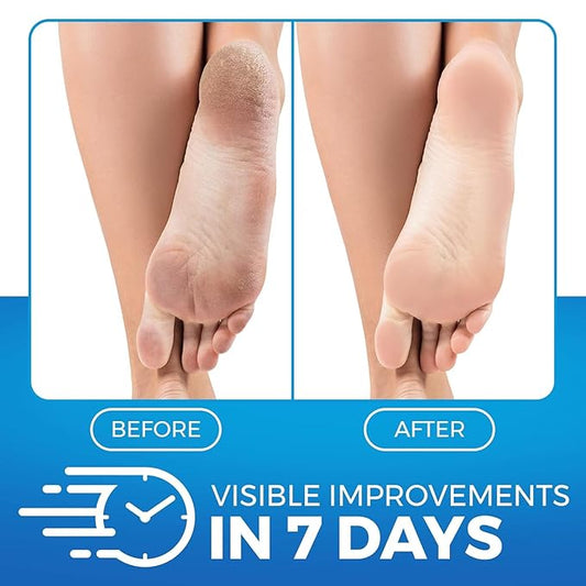 Imperial Feet Urea Foot Balm - Natural Urea Cream for Foot Care, Cracked Heel Repair, Rough Skin, Dryness, Calluses - Cleansing, Exfoliant - Wild Herb Extract - 5.07oz