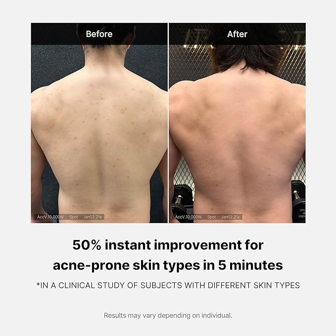 Medicube Red Acne Body Wash 14.10 Fl.oz I Low pH and Hydrating Cleanser with Salicylic Acid, Lactic Acid, Niacinamide and Hyaluronic Acid Suitable for Bacne Treatment | Korean Skin Care