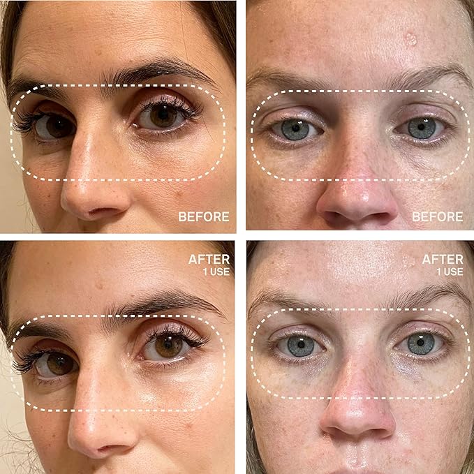 Dermaclara Eye & Mouth Patches - Anti-Wrinkle Silicone Patches for Smile Lines & Under Eye, Overnight Face Pads for Women & Men for Laugh & Frown Lines, Anti Aging, Reusable up to 30 Times - 4 Patches