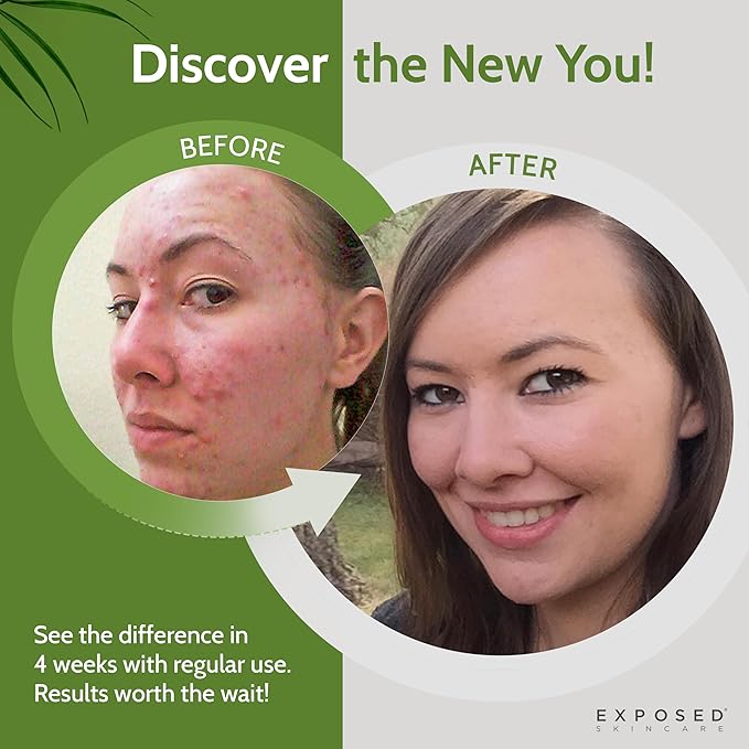 Exposed Skin Care, Acne Facial Cleanser with 0.5% Salicylic Acid for Sensitive and Acne-Prone Skin – Gentle Daily Face Wash for Breakout, Blackhead and Excess Oil – Natural, Non-toxic and Cruelty Free