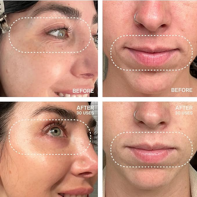 Dermaclara Eye & Mouth Patches - Anti-Wrinkle Silicone Patches for Smile Lines & Under Eye, Overnight Face Pads for Women & Men for Laugh & Frown Lines, Anti Aging, Reusable up to 30 Times - 4 Patches