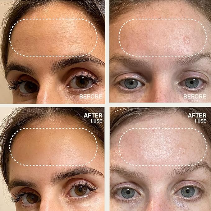 Dermaclara Forehead Patch - Forehead Wrinkle Patches for Face Overnight, Silicone Patches, Reusable Treatment for Wrinkles, Repair & Restore, Up to 30 Uses - 1 Patch